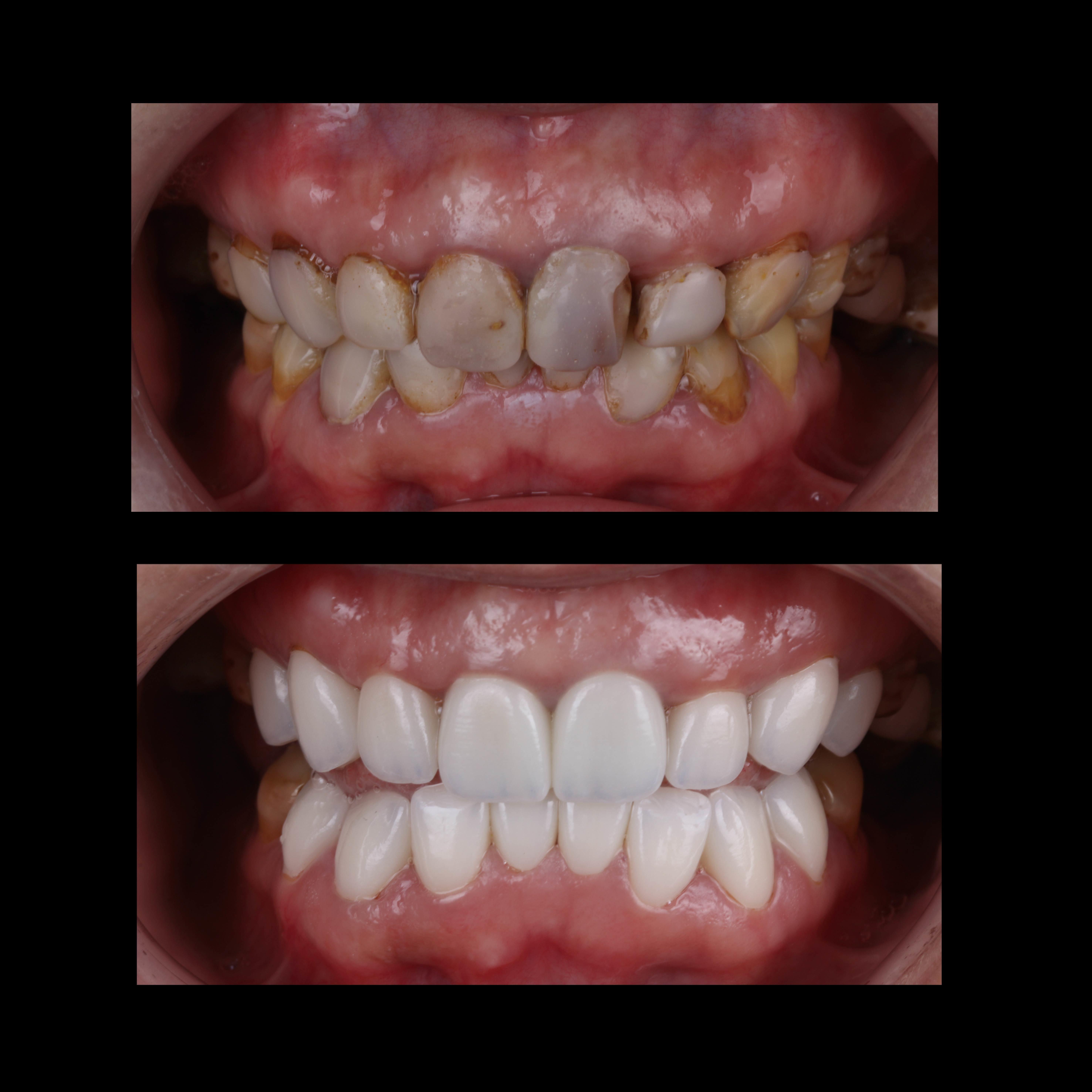 Case Study: Anterior All-Ceramic Crown & Bridge Restoration