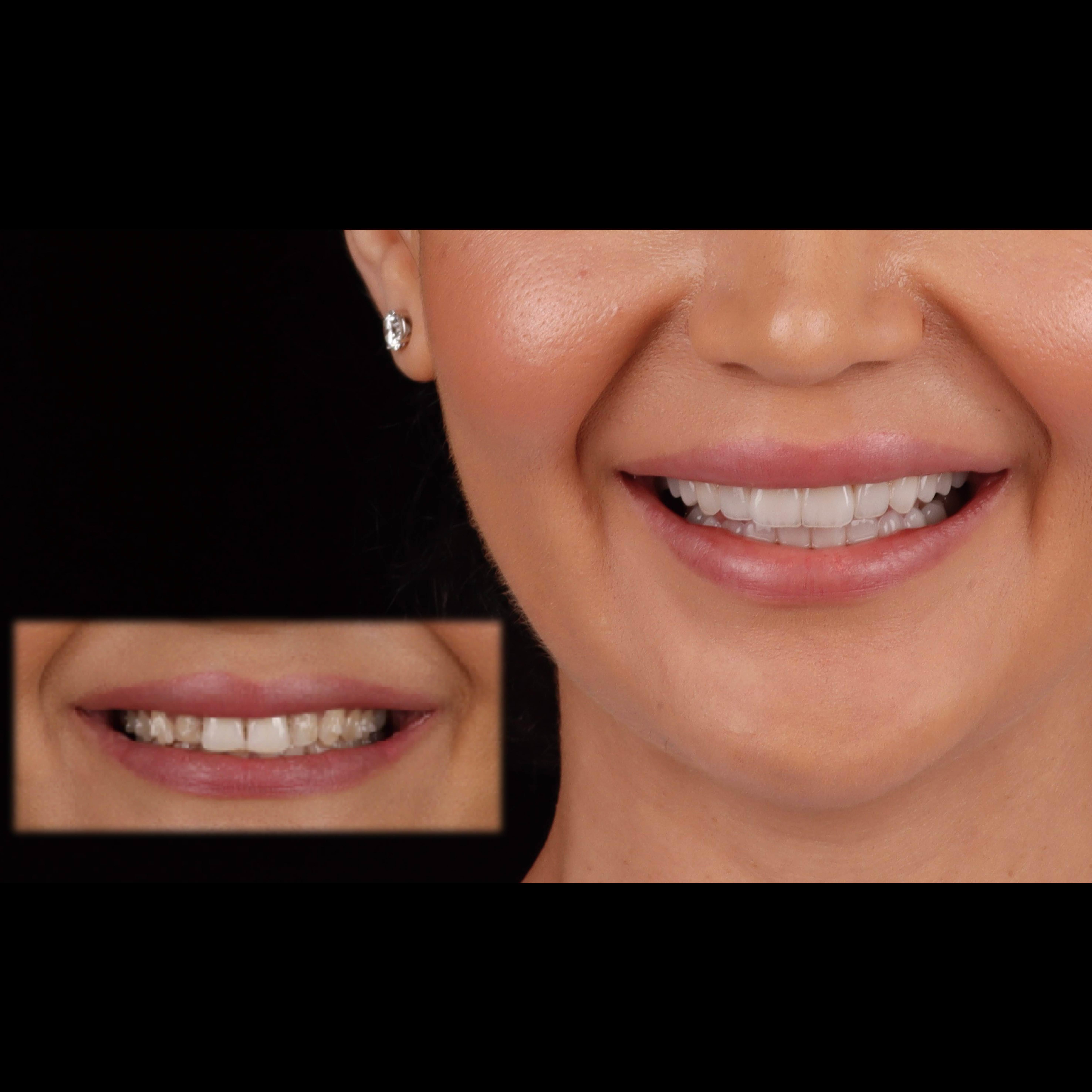 Case Study: Anterior All-Ceramic Veneer Aesthetic Restoration