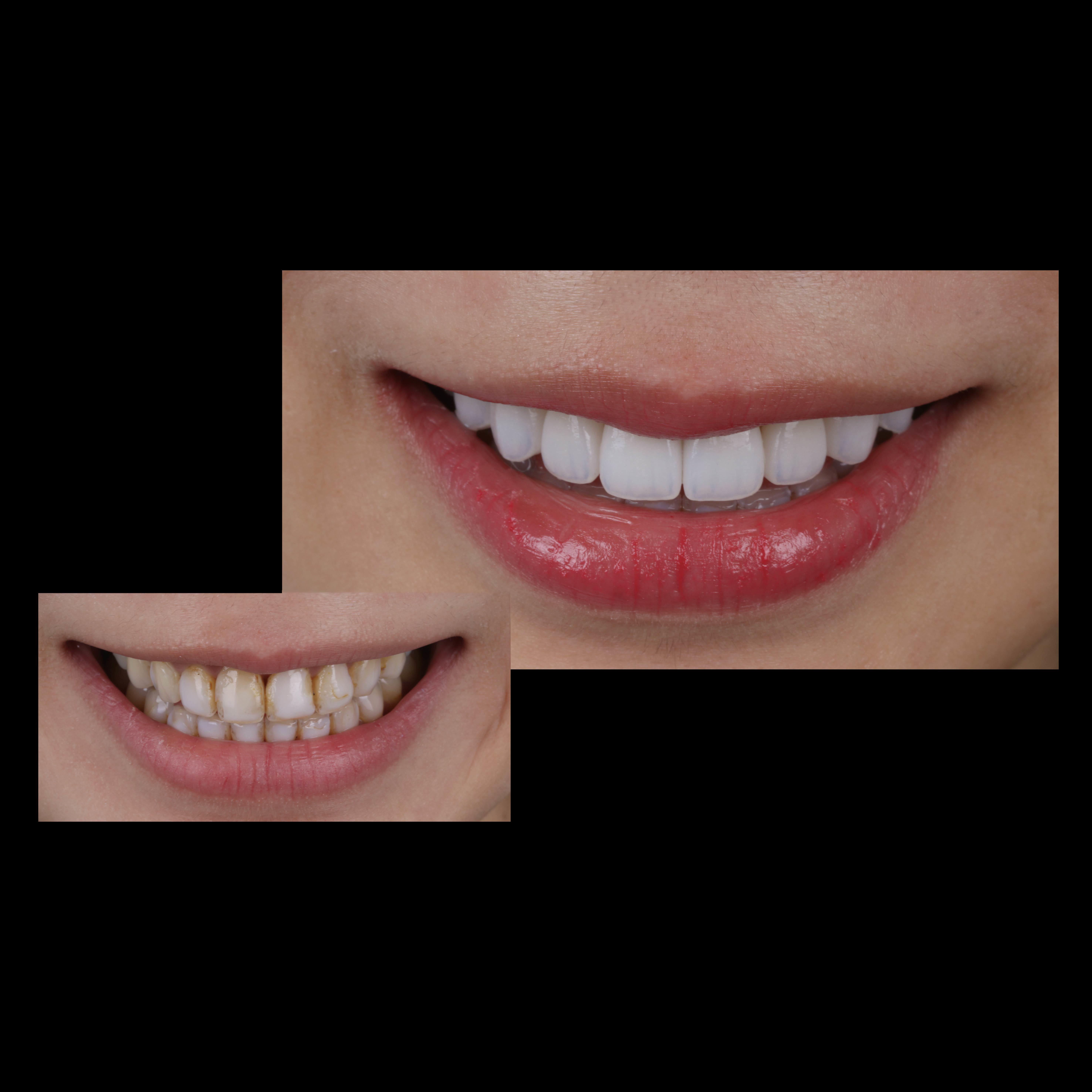 Anterior All-Ceramic Veneer Restoration
