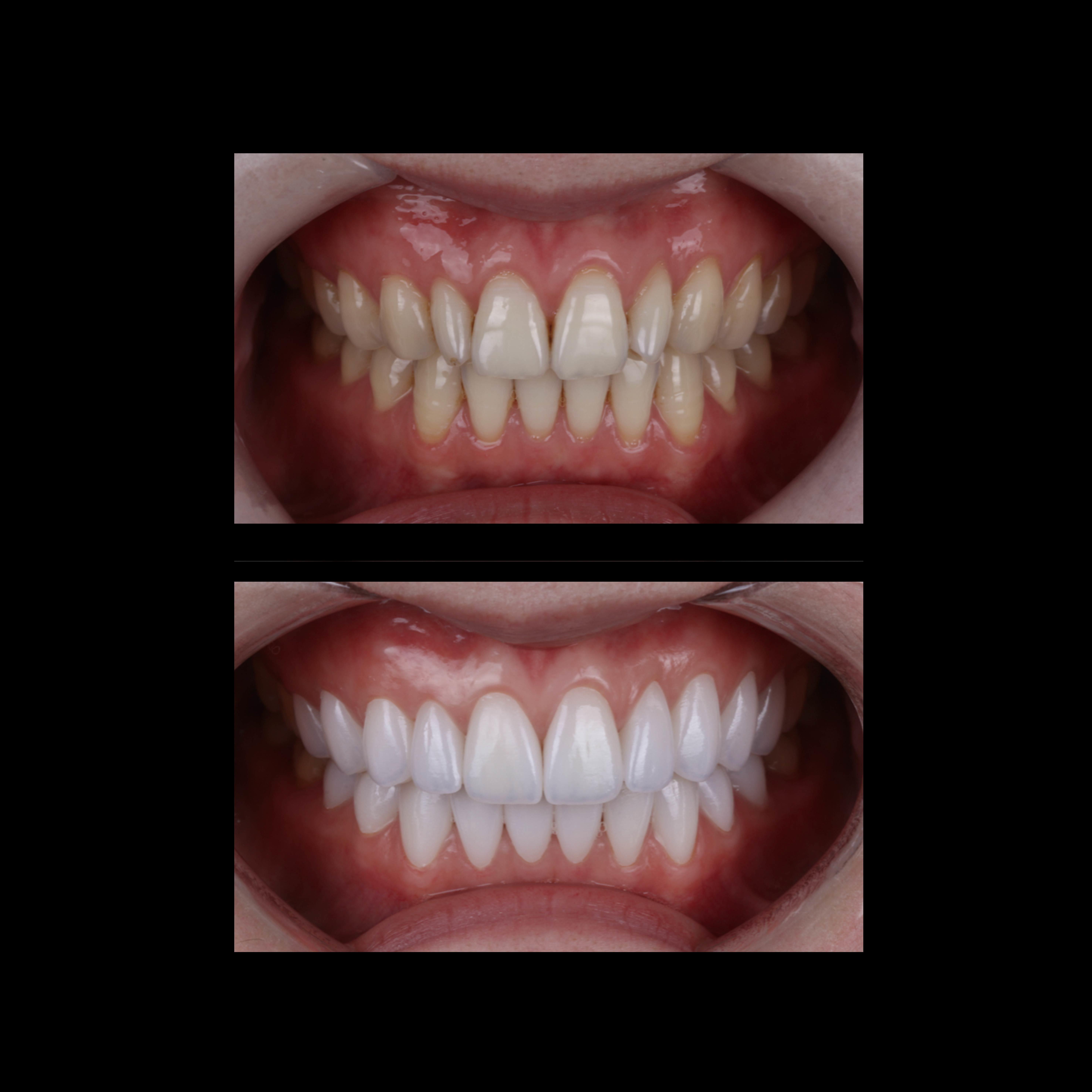 Case Study: Anterior All-Ceramic Crown Aesthetic Restoration
