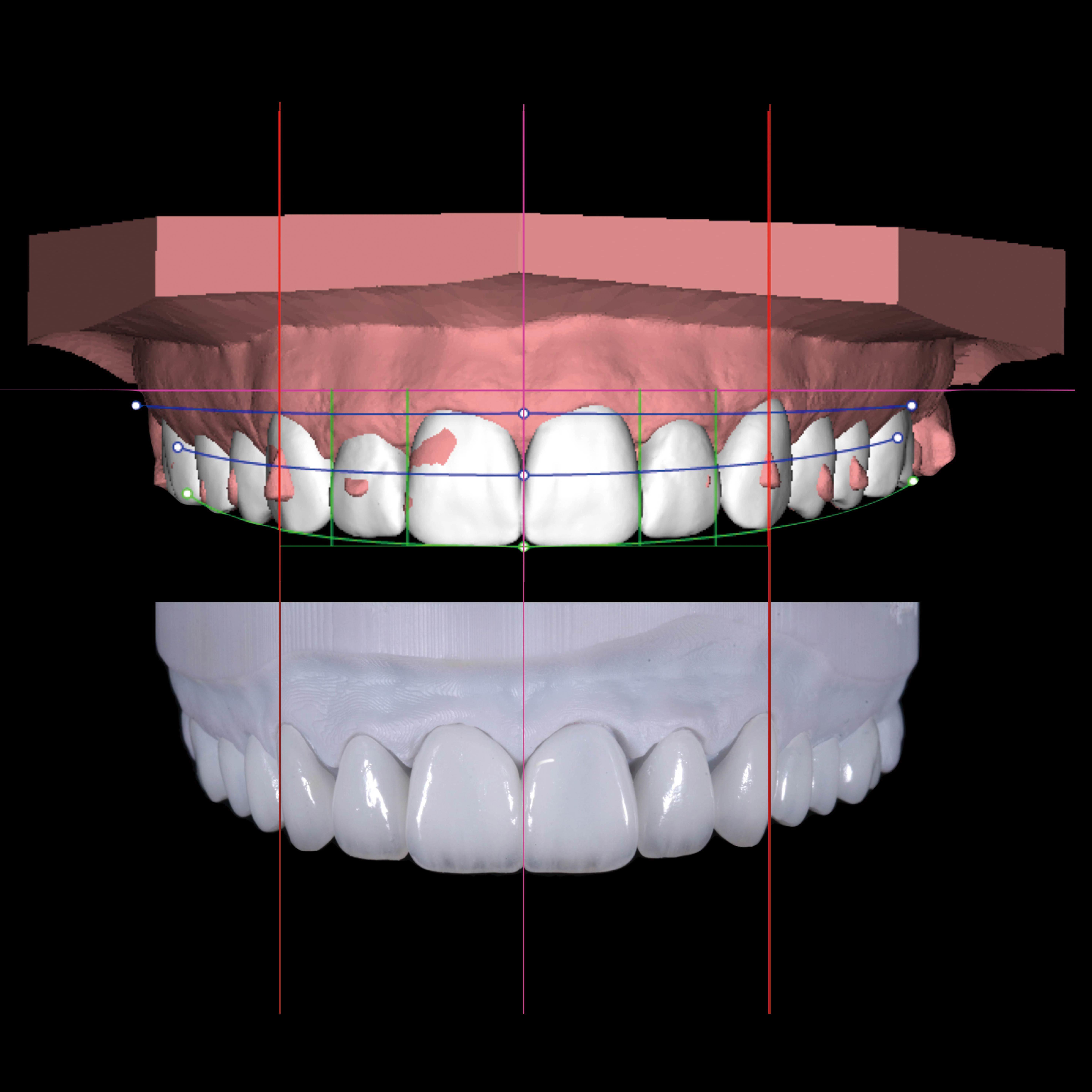 Case Study: Digital All-Ceramic Veneer Aesthetic Restoration