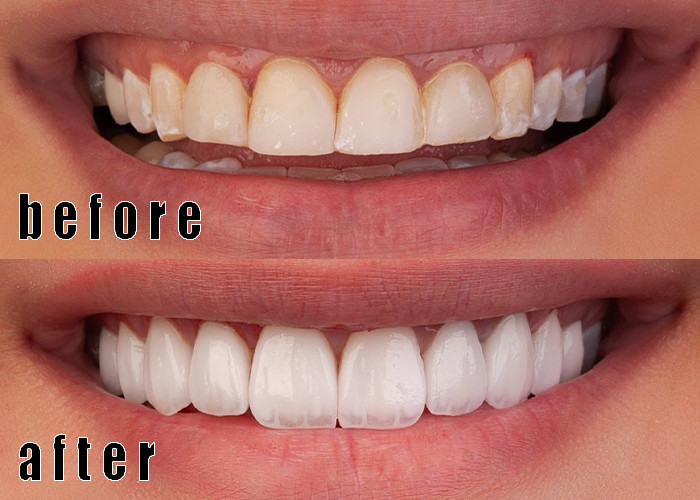emax veneer case 1