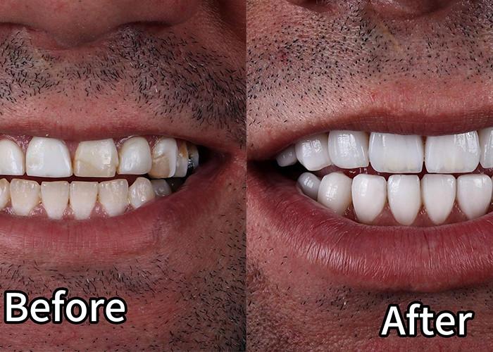 emax veneer case 2