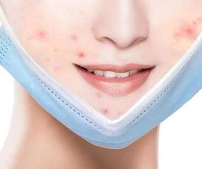 The weather is too hot, wearing a mask is sultry and acne?