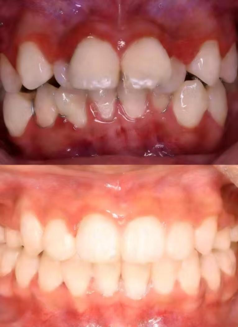 Prosthetic orthodontic appliance restoration