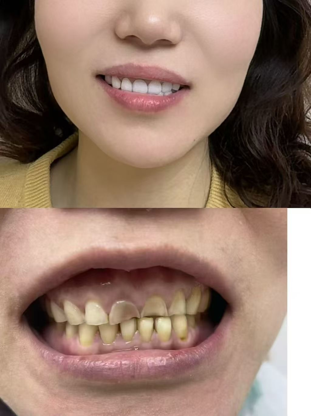 Emax Veneer restoration