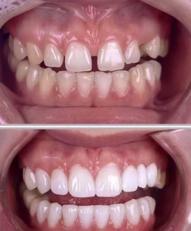 Ultra-Thin Porcelain Veneer Restoration