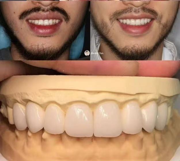 The Birth Story of a Boy’s “Star Teeth”｜From Messy Teeth to a Confident Smile