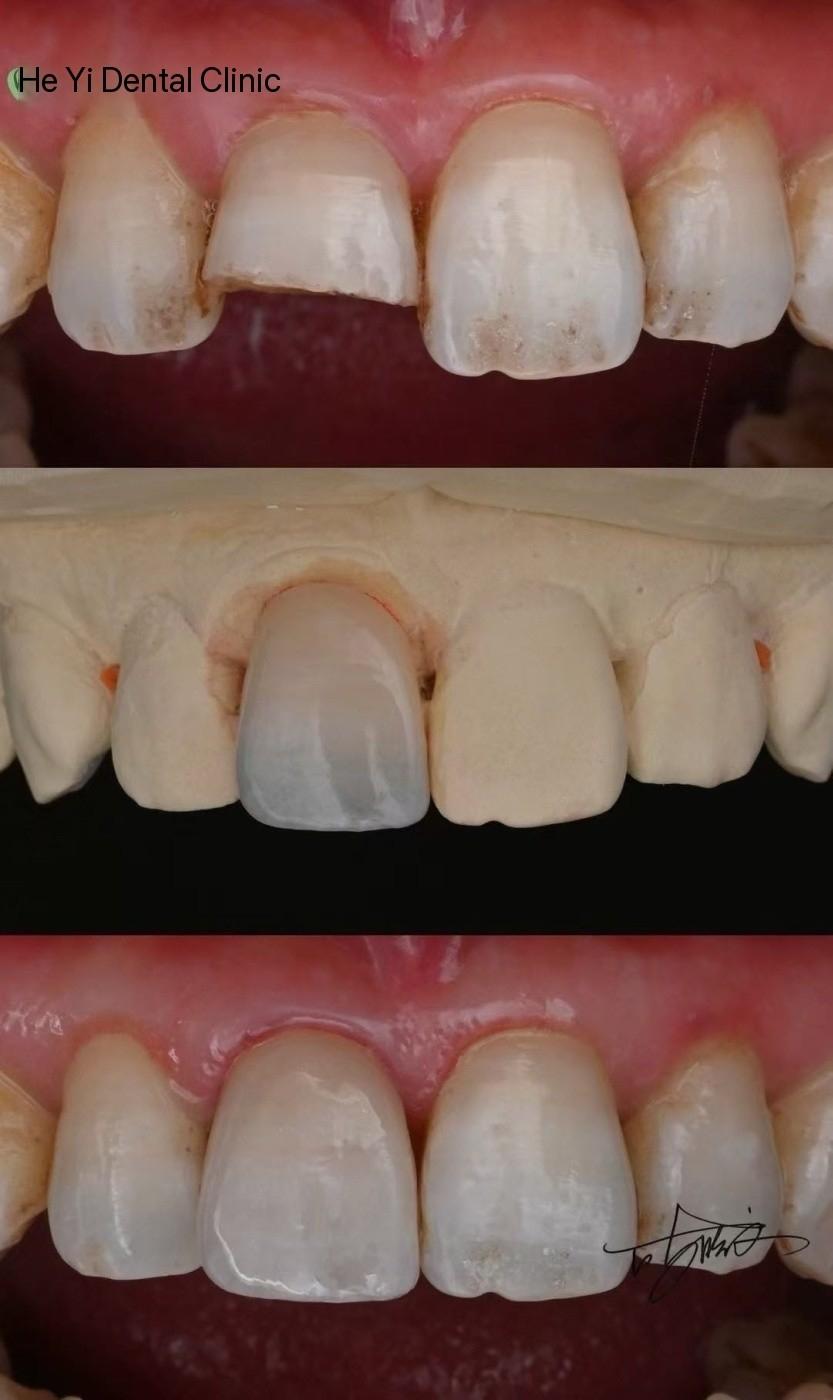 Super thin veneer