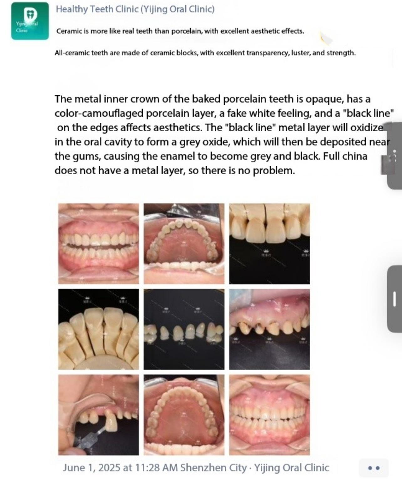 The characteristics and differences between all-ceramic teeth and porcelain-fused-to-metal teeth are introduced