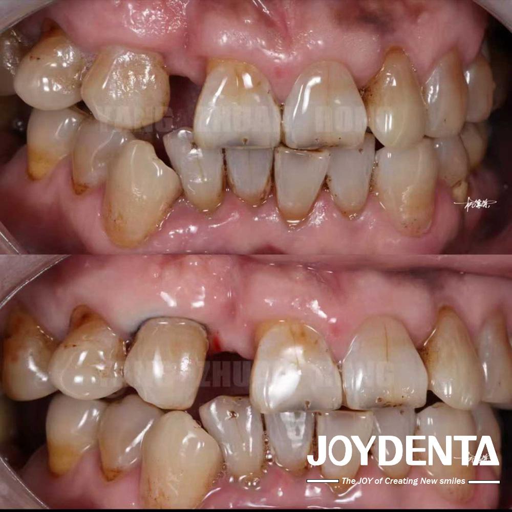 A Real Clinical Feedback Case from JoyDentalLab