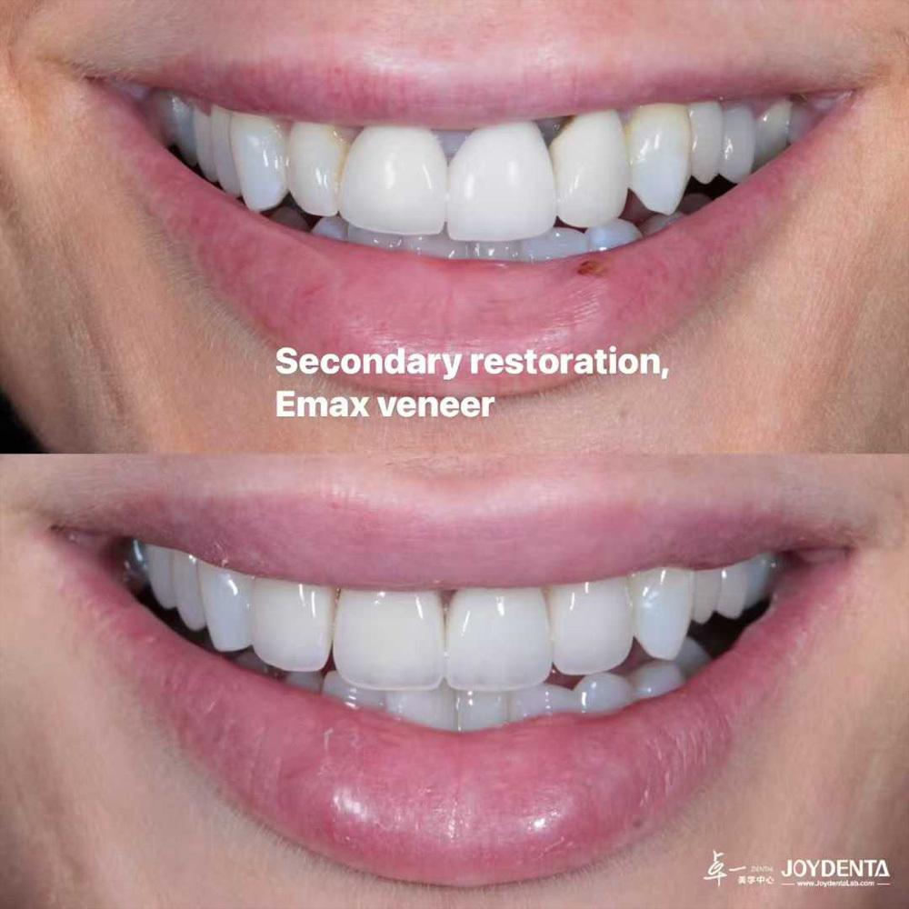 Upper Anterior 4-Unit Restoration for a UK Dental Laboratory