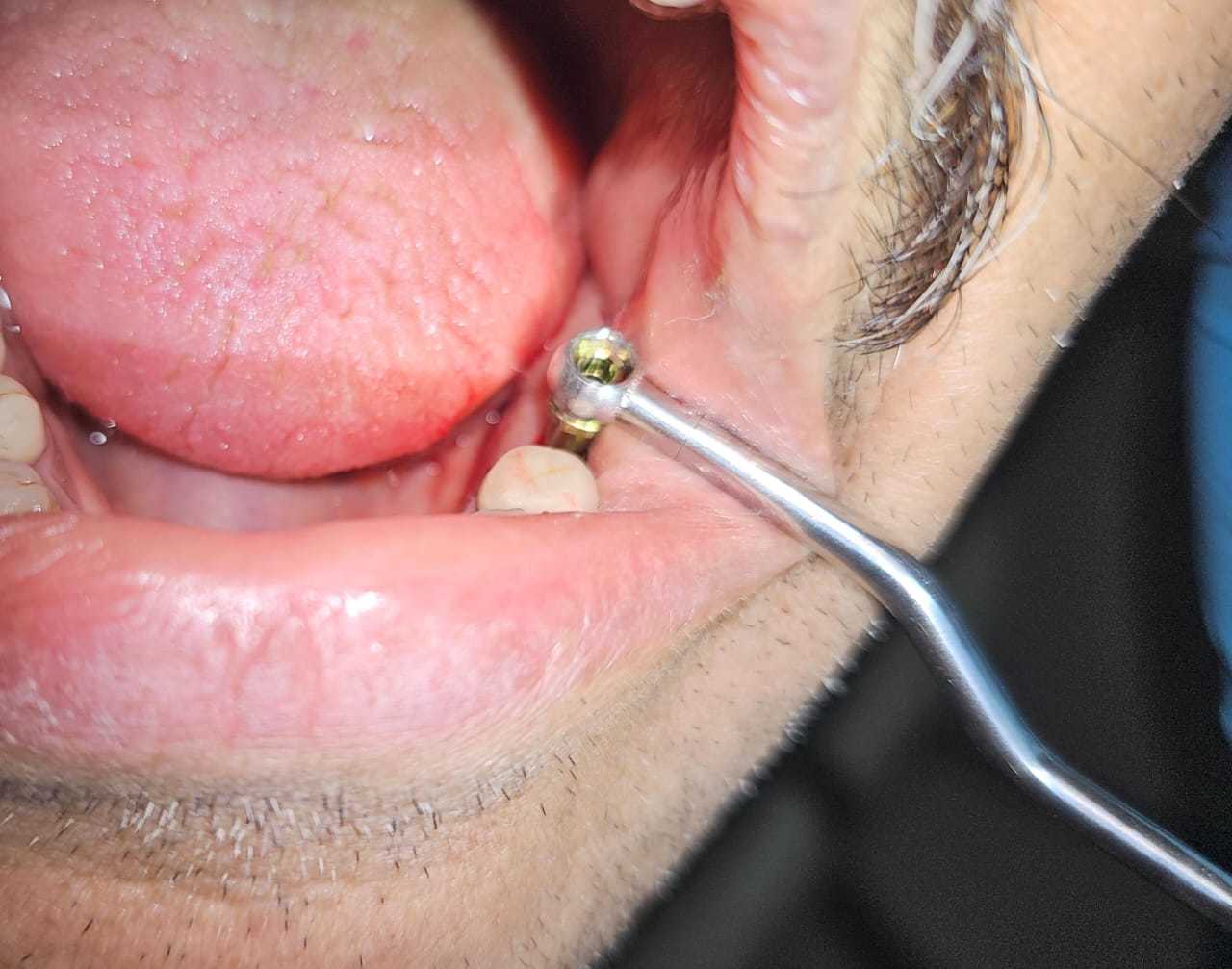 Indian Dentist Successfully Removes Broken Implant Screw Using Broken Screw Removal Kit