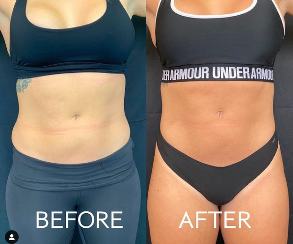 Treatments after Slimsculpting  machine