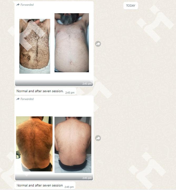 Male Chest & Back Hair Removal – 7-Session Success Case