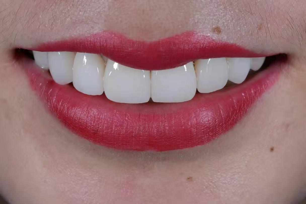 From Digital Design to Natural Beauty — A Veneer Case Crafted for Real-Life Smiles