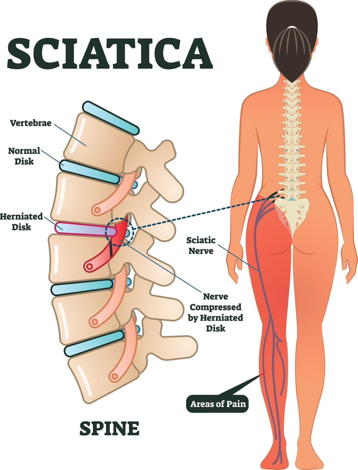 How much do you know about sciatica?