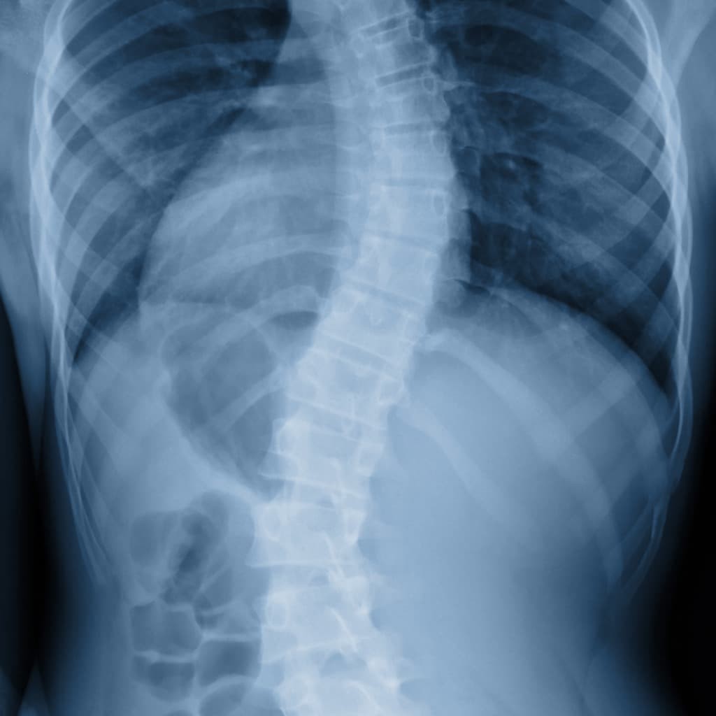 Scoliosis Causes and Symptoms